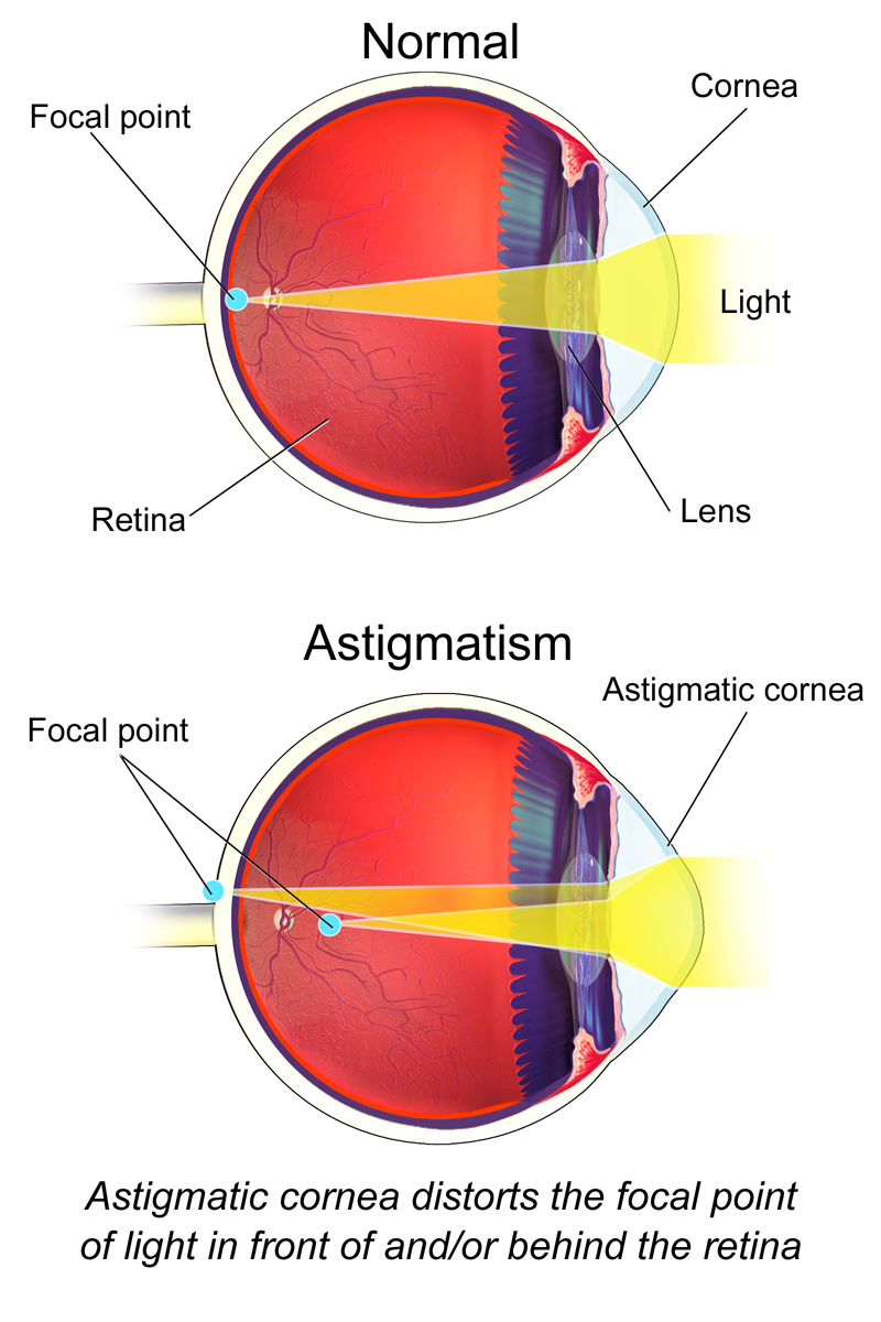 Astigmatism Treatment in Atlanta