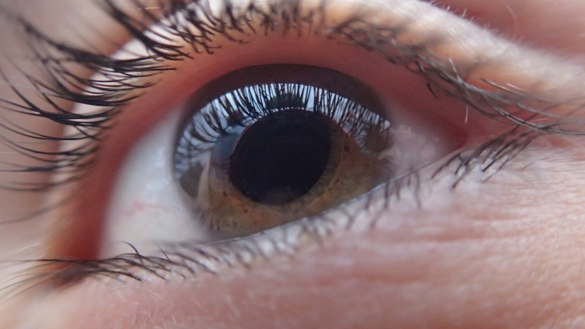 Corneal Transplant in Atlanta